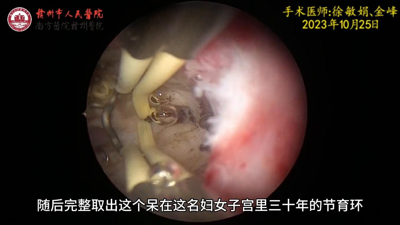 女性切除子宫手术过程详解，视频解析与科普